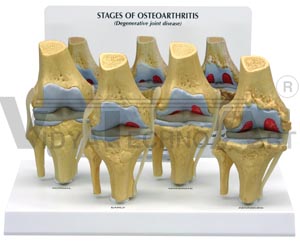 4-Stage Osteoarthritis Knee